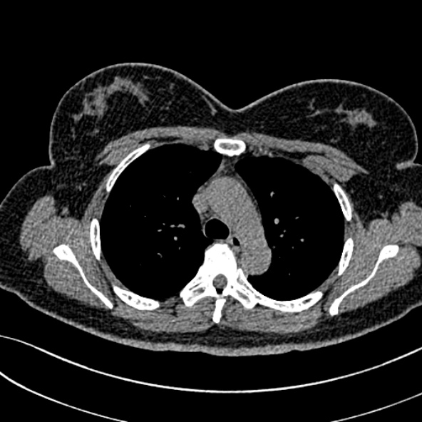 Normal CT chest- adult female (Radiopaedia 52522-58428 Axial non-contrast 44).jpg