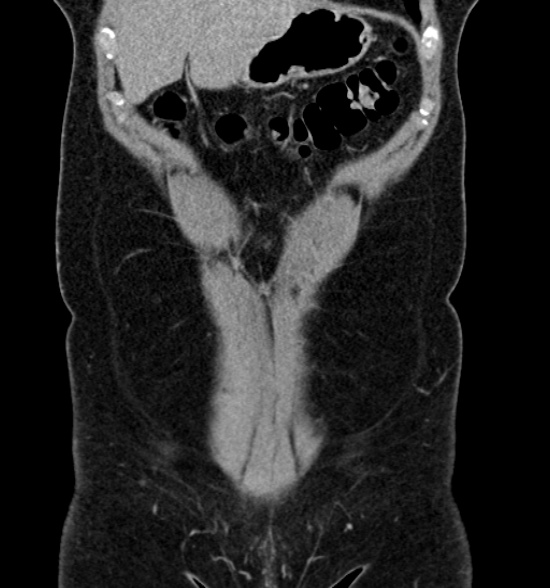 Normal CT intravenous urogram (Radiopaedia 39444-41759 A 186).jpg