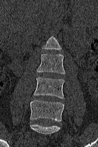 Normal CT lumbar spine (Radiopaedia 53981-60118 Coronal bone window 17).jpg