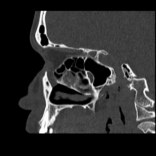 Normal CT paranasal sinuses (Radiopaedia 42286-45390 Sagittal bone window 37).jpg