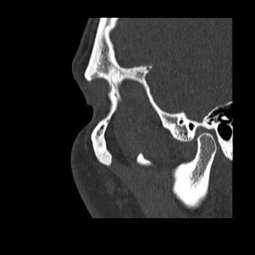 Normal CT paranasal sinuses (Radiopaedia 42286-45390 Sagittal bone window 5).jpg
