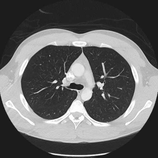 Normal CT pulmonary veins (pre RF ablation) (Radiopaedia 41748-44702 Axial lung window 7).png