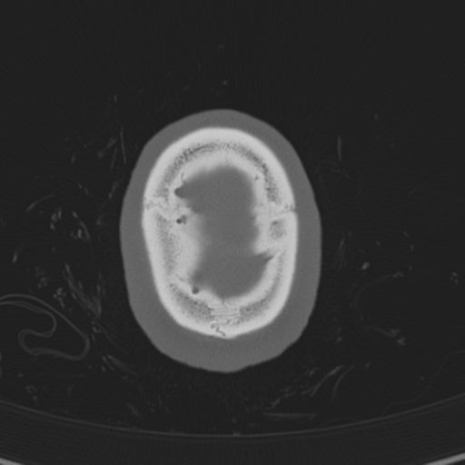 Normal CT skull (Radiopaedia 40798-43459 A 147).png