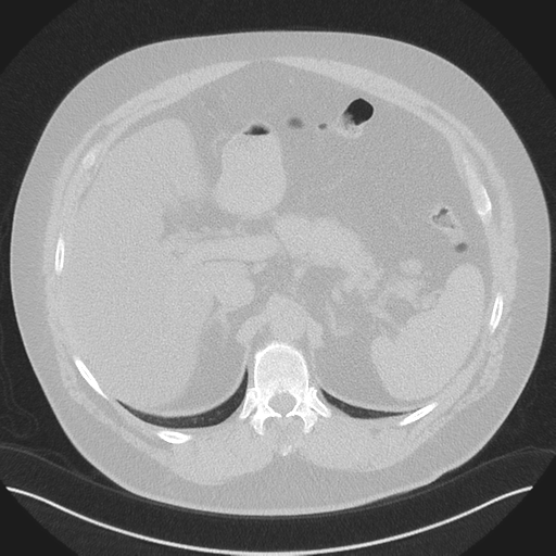 Normal HRCT (Radiopaedia 40797-43458 Axial lung window 59).png