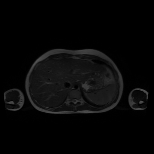 File:Normal MRI abdomen in pregnancy (Radiopaedia 88001-104541 Axial T2 8).jpg
