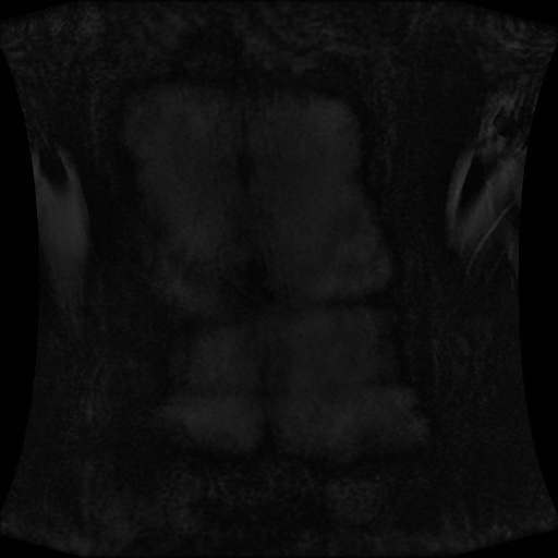 Normal MRI abdomen in pregnancy (Radiopaedia 88001-104541 N 1).jpg