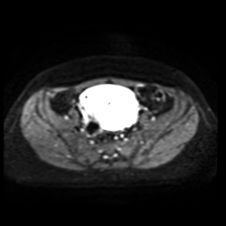Normal MRI abdomen in pregnancy (Radiopaedia 88005-104548 Axial DWI 24).jpg