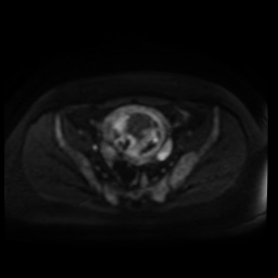 Normal MRI abdomen in pregnancy (Radiopaedia 88005-104548 Axial DWI 93).jpg