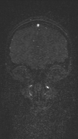 Normal MRI brain with MRV- teenager (Radiopaedia 49425-54553 Coronal MRV 59).jpg