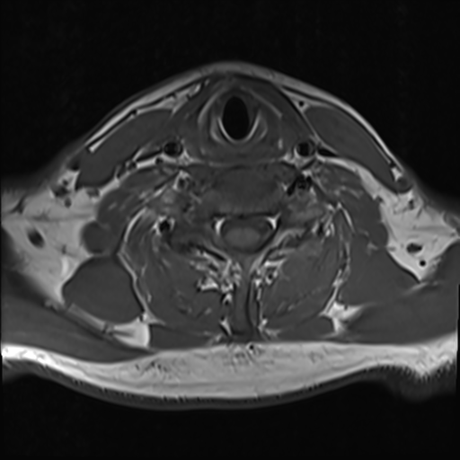File:Normal MRI cervical spine (infection protocol) (Radiopaedia 53916-60039 Axial 36).png