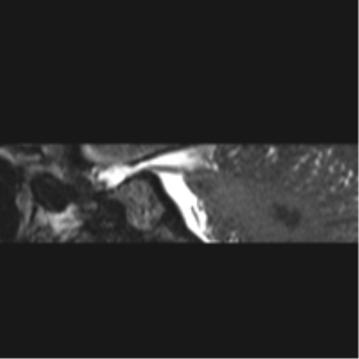 Normal MRI internal auditory canal (Radiopaedia 41613-44525 C 44).png
