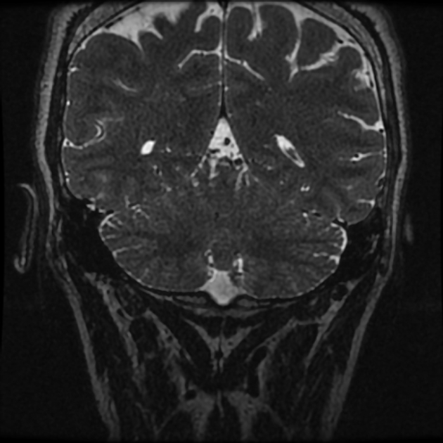 Normal MRI petrous (Radiopaedia 91317-108949 Coronal T2 111).jpg