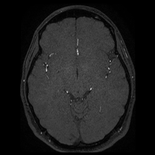 Normal brain MRA (Radiopaedia 41046-43793 Axial MRA 38).png