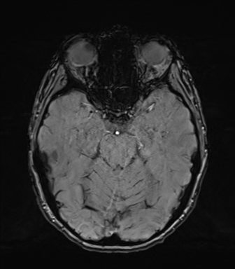 Normal brain MRI (TLE protocol) (Radiopaedia 40748-43405 Axial SWI 31).png