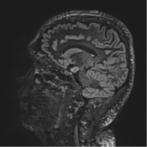 Normal brain MRI (non-focal epilepsy protocol) (Radiopaedia 53917-60040 Sagittal DIR 38).png