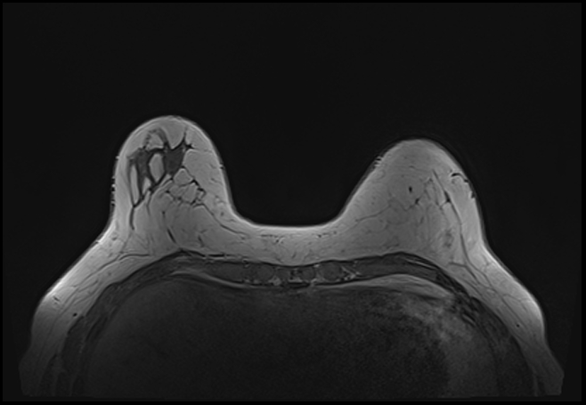 File:Normal breast MRI - dense breasts (Radiopaedia 80454-93850 Axial T1 52).jpg