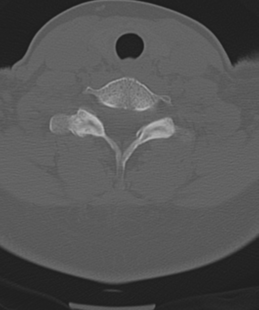 Normal cervical spine MRI (including Dixon) (Radiopaedia 42762-45926 Axial bone window 45).png