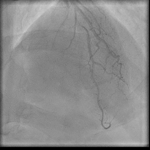 Normal coronary angiogram (DSA) (Radiopaedia 63081-71571 E 78).jpg
