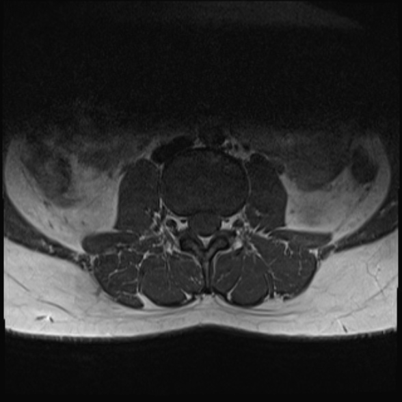 File:Normal lumbar spine MRI- 3 T (Radiopaedia 53280-59250 Axial 8).jpg
