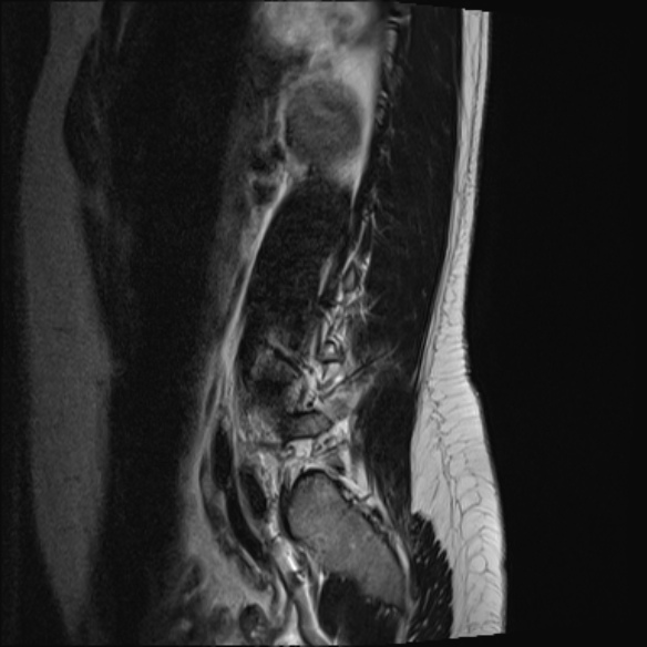 File:Normal lumbar spine MRI- 3 T (Radiopaedia 53280-59250 Sagittal T2 21).jpg