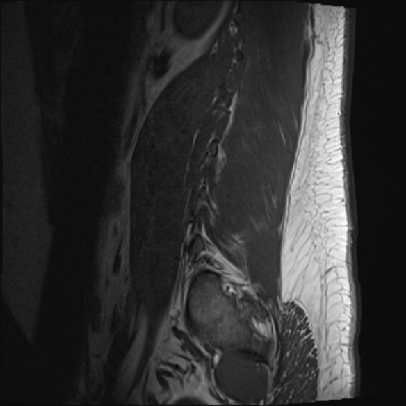File:Normal lumbar spine MRI (Radiopaedia 47857-52609 Sagittal T1 20).jpg