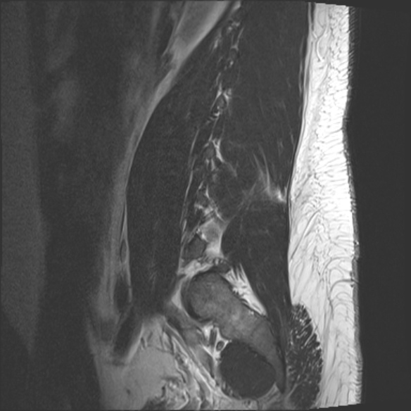 File:Normal lumbar spine MRI (Radiopaedia 47857-52609 Sagittal T2 1).jpg