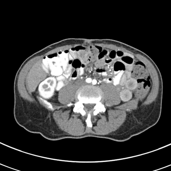 File:Normal multiphase CT liver (Radiopaedia 38026-39996 B 54).jpg