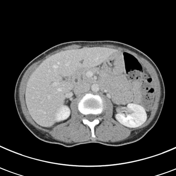 File:Normal multiphase CT liver (Radiopaedia 38026-39996 C 31).jpg