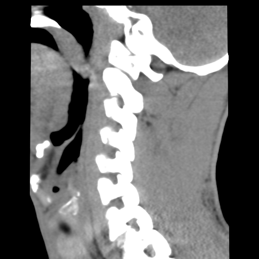 File:Normal trauma cervical spine (Radiopaedia 41017-43760 B 10).png