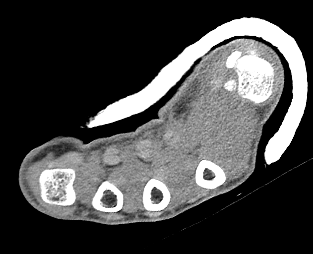 Normal wrist CT (Radiopaedia 41425-44297 Axial non-contrast 11).png