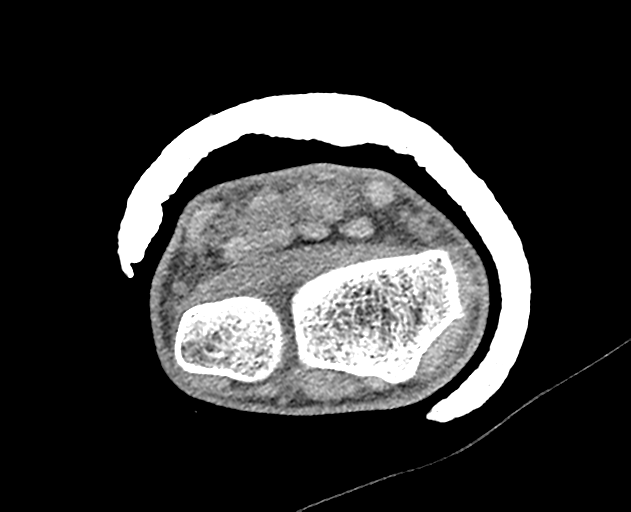 Normal wrist CT (Radiopaedia 41425-44297 Axial non-contrast 40).png
