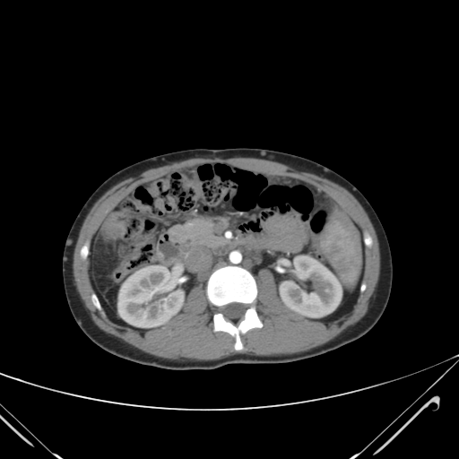 File:Nutmeg liver- Budd-Chiari syndrome (Radiopaedia 46234-50635 A 35).png