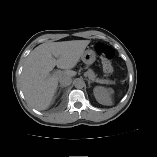 File:Obstructed kidney with perinephric urinoma (Radiopaedia 26889-27066 Axial non-contrast 8).jpg