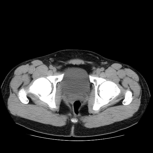 File:Obstructing ureteric calculus (Radiopaedia 18615-18514 Axial non-contrast 54).jpg