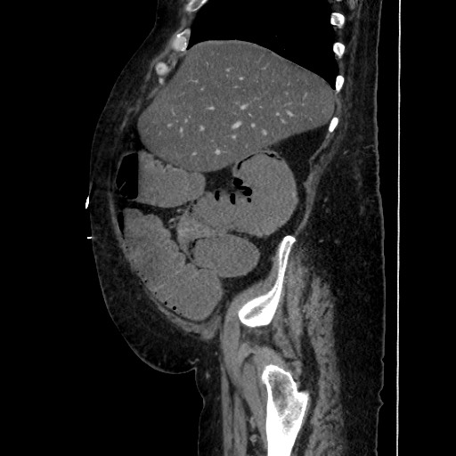 Obstructive colonic diverticular stricture (Radiopaedia 81085-94675 C 65).jpg
