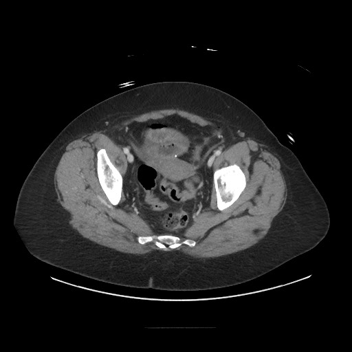 Obstructive distal colonic adenocarcinoma causing cecal perforation (Radiopaedia 86830-102989 A 168).jpg