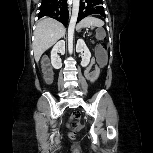 Obstructive distal colonic adenocarcinoma causing cecal perforation (Radiopaedia 86830-102989 C 119).jpg