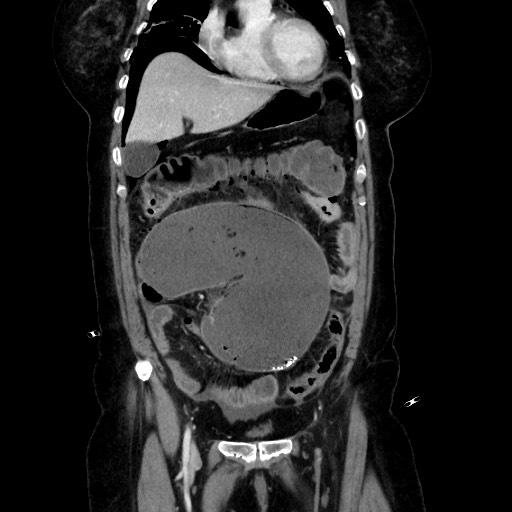 Obstructive distal colonic adenocarcinoma causing cecal perforation (Radiopaedia 86830-102989 C 71).jpg