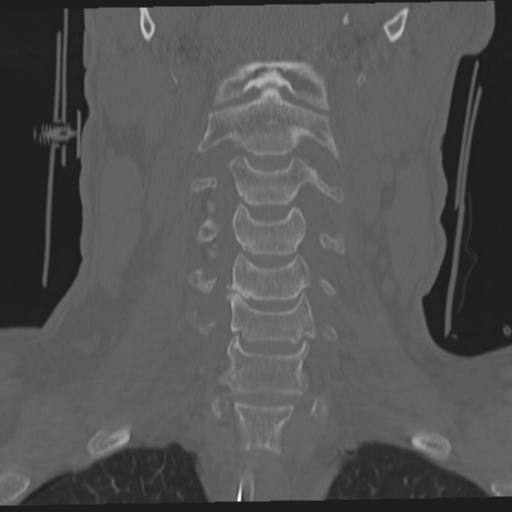 File:Occipital condyle fracture (Radiopaedia 33467-34517 Coronal bone window 25).png