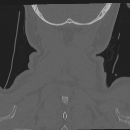 File:Occipital condyle fracture (Radiopaedia 33467-34517 Coronal bone window 66).png