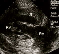 RV inflow view showing marked right ventricular hypertrophy