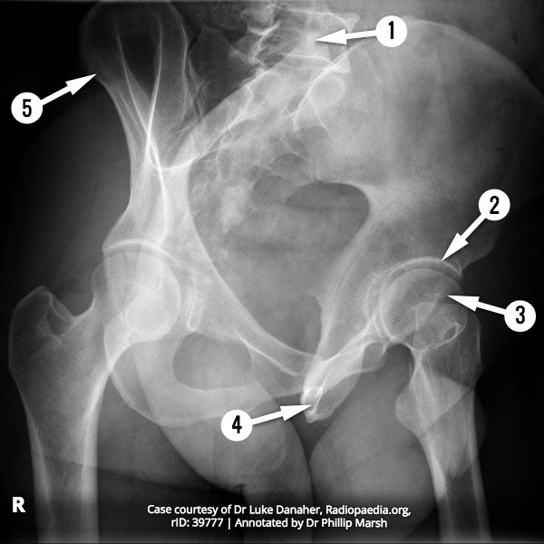 File:Pelvis radiograph - right Judet view (anatomy quiz) (Radiopaedia 62437).jpg