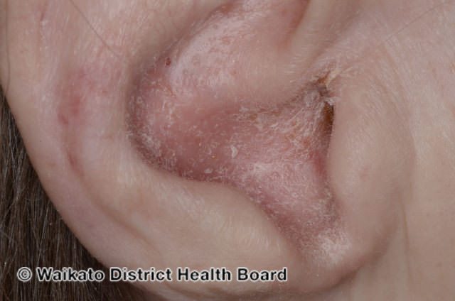 File:Sebopsoriasis of ear (DermNet NZ scaly-w-sebopsoriasis-1).jpg
