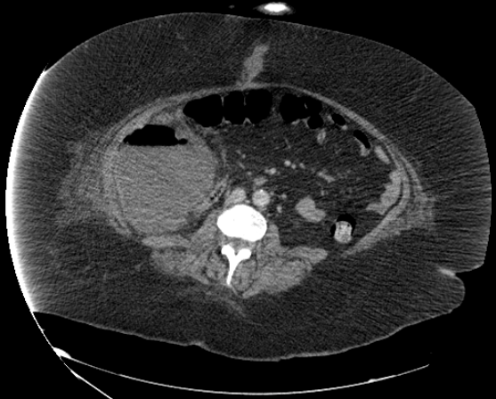 File:Abdominal abscess - pre and post percutaneous drainage (Radiopaedia 60209-67816 Axial 10).png