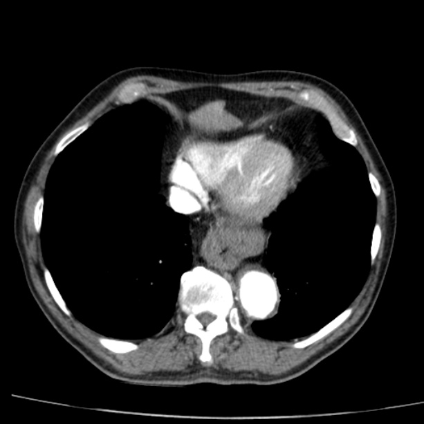 Abdominal aortic aneurysm (Radiopaedia 29248-29660 Axial C+ arterial phase 4).jpg