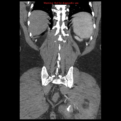 Abdominal aortic aneurysm (Radiopaedia 8190-9038 Coronal C+ arterial phase 107).jpg