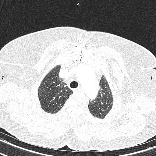 File:Abdominal aortic aneurysm (Radiopaedia 85063-100606 Axial lung window 18).jpg