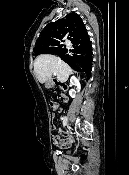 Abdominal aortic aneurysm (Radiopaedia 85063-100606 Sagittal C+ arterial phase 28).jpg