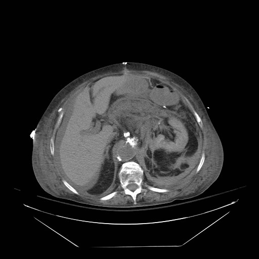 Abdominal aortic aneurysm - impending rupture (Radiopaedia 19233-19247 Axial non-contrast 56).jpg