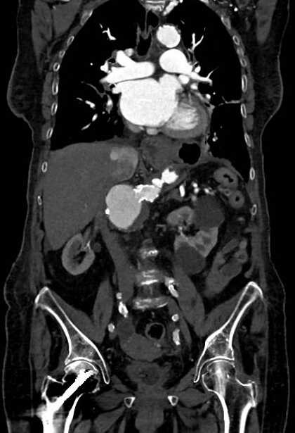 Abdominal aortic aneurysm with thrombus fissuration (Radiopaedia 73192-83919 Coronal C+ arterial phase 44).jpg